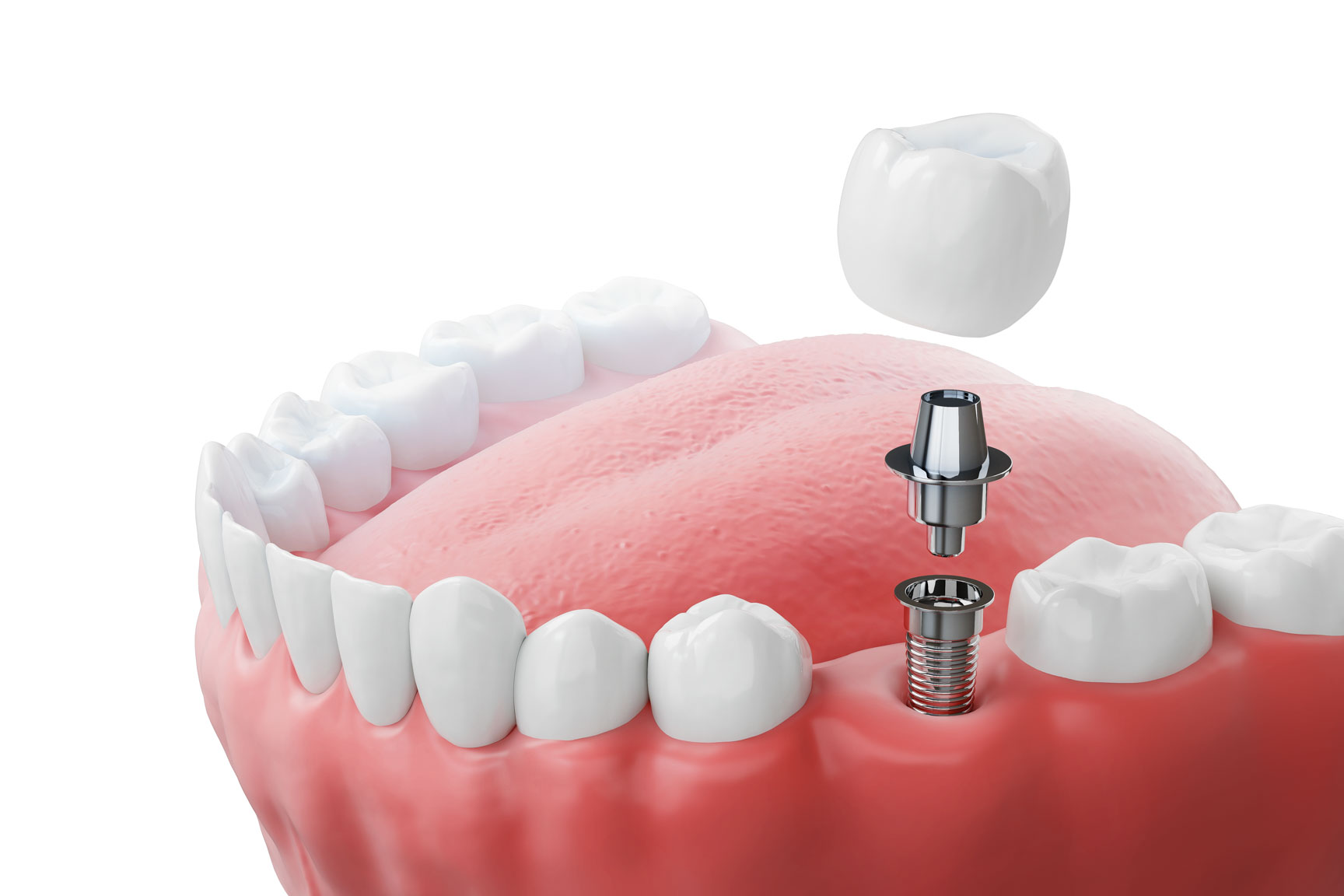 Dental implant placement illustration